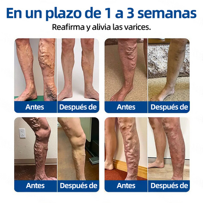 𝗛𝗲𝗮𝗹𝗿𝗶𝘇𝗲® 𝗣𝗮𝗿𝗰𝗵𝗲 𝗠𝗶𝗰𝗿𝗼𝗻𝗲𝗲𝗱𝗹𝗲 𝗩𝗲𝗶𝗻𝗧𝗮𝗿𝗴𝗲𝘁 𝗔𝗹𝗶𝘃𝗶𝗼 𝗜𝗻𝘀𝘁𝗮𝗻𝘁𝗮́𝗻𝗲𝗼, 𝗥𝗲𝘀𝘂𝗹𝘁𝗮𝗱𝗼𝘀 𝗮 𝗟𝗮𝗿𝗴𝗼 𝗣𝗹𝗮𝘇𝗼🌾🌽🇪🇸